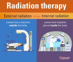 Radiation therapy.