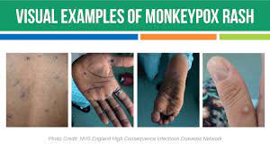 The spread of monkey pox.