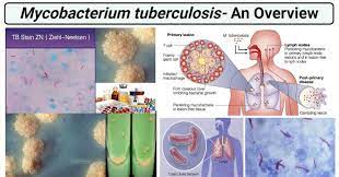 Mycobacterium tuberculosis.