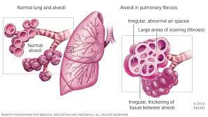Pulmonary Fibrosis disease.