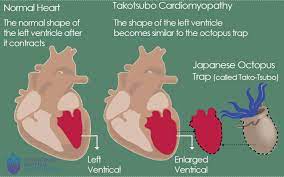Takotsubo Cardiomyopathy