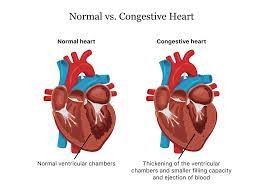 Congestive Heart Failure.