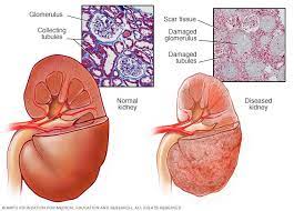 End-stage renal failure