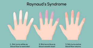 Raynaud syndrome.